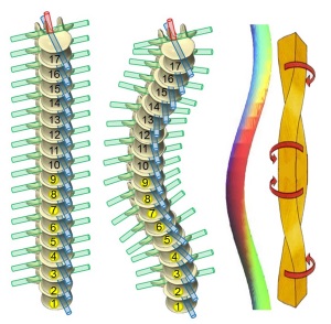 Clasificarea tipurilor de scolioză, tipuri, forme, gradul de curbură a coloanei vertebrale