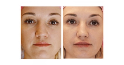 Contur plastic facial, buze, pliuri nasolabiale, pometi, clinica - Elena, Novosibirsk