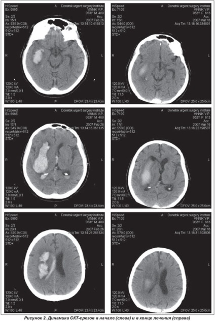 Tratamentul accident vascular cerebral hemoragic în departamentul neurologic urban,