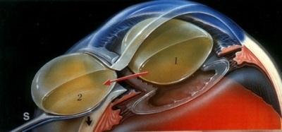 Tratamentul cauzelor de cataractă, simptome, metode, cum se tratează și dacă este posibil să se vindece
