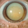 Tratamentul cauzelor de cataractă, simptome, metode, cum se tratează și dacă este posibil să se vindece