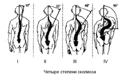 Tratamentul scoliozelor coloanei vertebrale la copii caracteristici importante