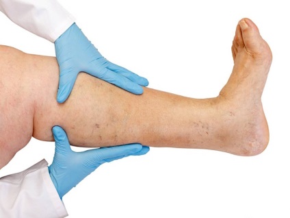 Лечение на разширени вени на краката при жените