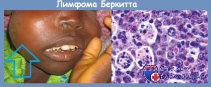 Limfom berkitta - clinică, diagnostic, tratament