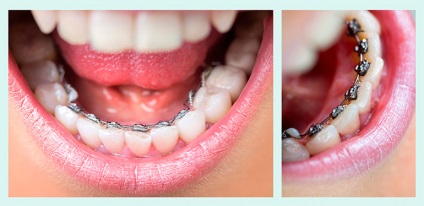 Lingual braces înainte și după fotografii, 15 imagini