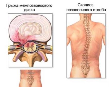 Мануальна терапія хребта і його лікування при переломі або зміщенні