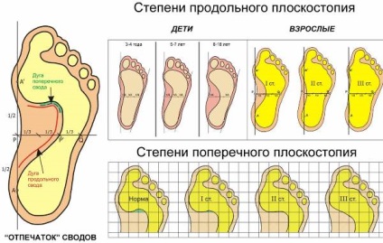 Masaj cu picioare plate la copii cu simptome, tratament și exerciții