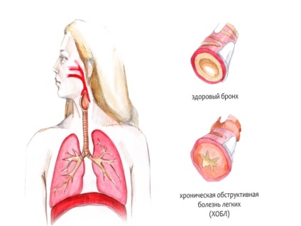 Consecințele medicale ale fumatului cronic și acut - pentru fumat