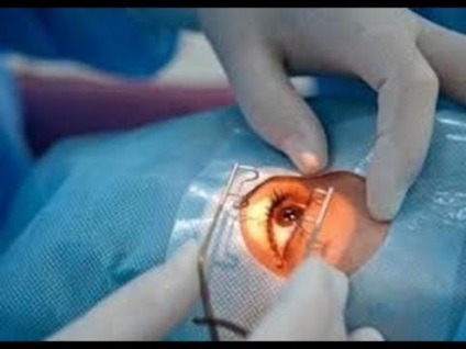 Produsele medicale utilizate în timpul operațiilor oftalmice - vii sănătoși