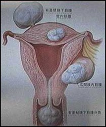 Myomul uterului, tratamentul miomelor cervicale fără intervenție chirurgicală în clinică