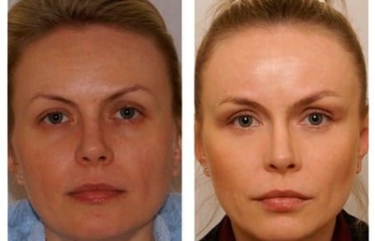 Face myostimulation fotó hozzászólás előtt és után