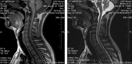 Mirtul coloanei vertebrale cervicale de la Moscova, unde poți să faci ieftin la un cost redus, cu contrast