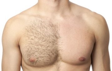 Îndepărtarea părului la bărbați, tehnica de îndeplinire și îngrijirea pielii după procedură