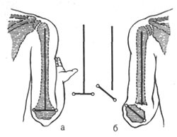 Supra- și supra-locomotorii fracturi de humerus la copii