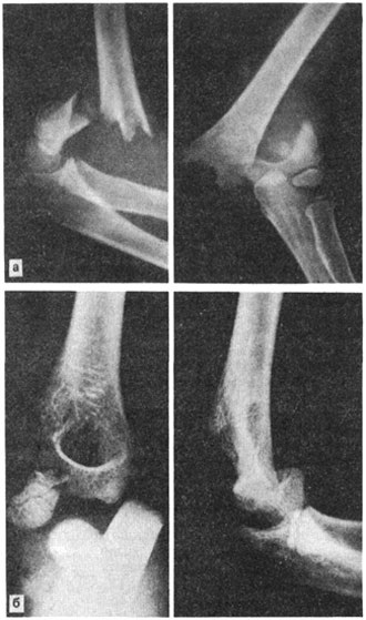 Supra- și supra-locomotorii fracturi de humerus la copii