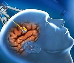 Neurinomul creierului și măduvei spinării, simptomele nervului auditiv și tratamentul