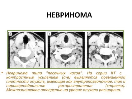 Neurinomul creierului și măduvei spinării, simptomele nervului auditiv și tratamentul