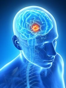 Neurinomul creierului provoacă, simptomele, diagnosticul