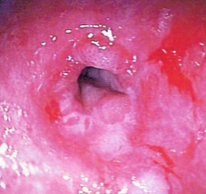 Sclerodermia sistemică limitată (sindrom crest) și tratamentul bolii de colagen