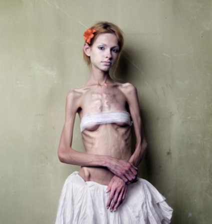 Veszélyes eszközök anorexia okozta hányás, hashajtók és vízhajtók