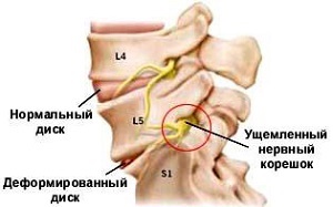 Osteochondrosis az okok, tünetek és a kezelés a betegség