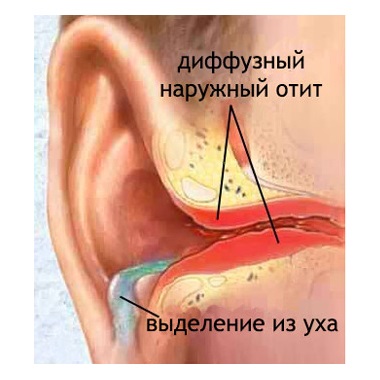 Akut gyulladásos és fertőző betegségek a középfül - influenzaellenes otitis kezelés Moszkva