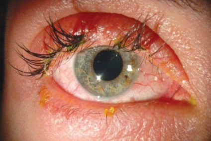 Arsuri la nivelul ochilor - cauze, simptome, diagnostic și tratament