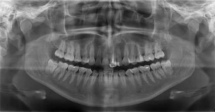 Imagine panoramică (raze x) a dinților din Novgorodul inferior