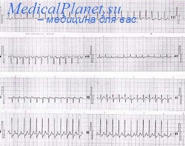 Parasystole az EKG (elektrokardiogram on parasystole) Parasystole az EKG