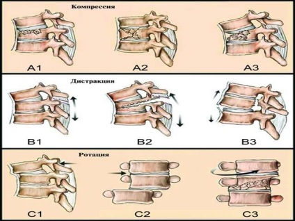Fractura coloanei vertebrale