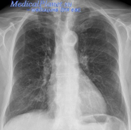 Edem pulmonar perifocal sau colateral