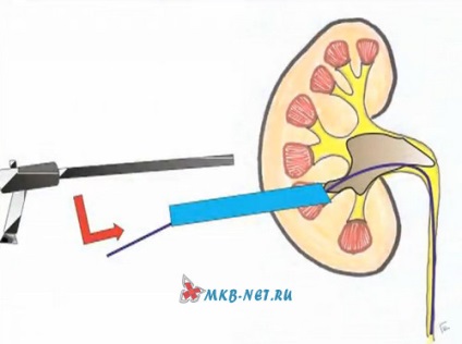 Nephrolitholapaxia percutanată - răspunsuri la întrebări