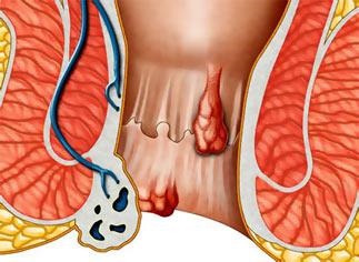 Nutriție după îndepărtarea hemoroizilor