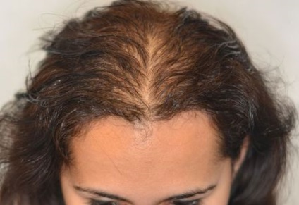 De ce apare alopecia difuza la femei?