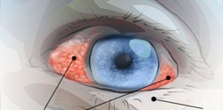 Roșeața proteinei oculare - cauze, tratament, picături pentru ochi