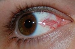 Roșeața proteinei oculare - cauze, tratament, picături pentru ochi