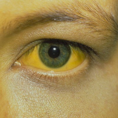 Roșeața proteinei oculare - simptome, tratament, cauze