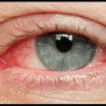 Roșeața cauzată de proteinele oculare și tratamentul la adulți și copii, în jurul pielii, mâncărime, sclera