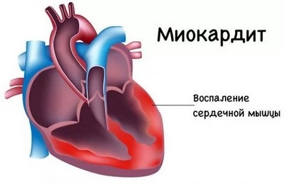 Cardiografia postmiocardică ce este, cauzele și tratamentul - informații despre sănătate