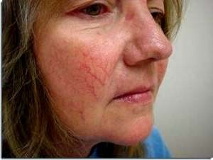 Előkészületek a rosacea kezelésére az arcon, a népi gyógyászat