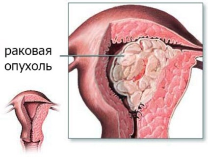 Semne de apendicită la fete - cum să se facă distincția între procesele acute din apendicele uterului