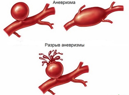 Durere pulsantă în cap - cauze, tratament, eliminare