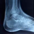 Heel spurs - tratament într-o rețea de capital clinic