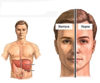 Racul ganglionului limfatic în simptomele gâtului, simptomele și tratamentul