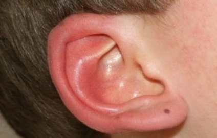 Cancer de ureche (ureche) la om - primele semne, simptome, uzi