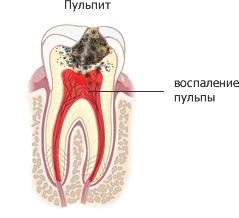 Розкришився або згнив зуб мудрості карієс і пульпіт