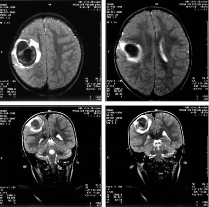 Decodarea paraliziei cerebrale