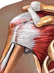 Stretching-ul ligamentelor din tratamentul articulațiilor umărului, simptome și cauze