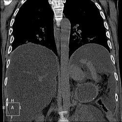 Radiografie și cancer pulmonar
