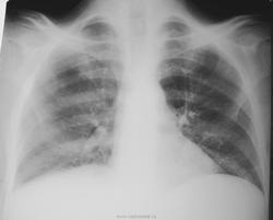 Radiografie și cancer pulmonar